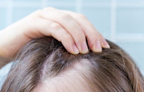 female-baldness-treatment