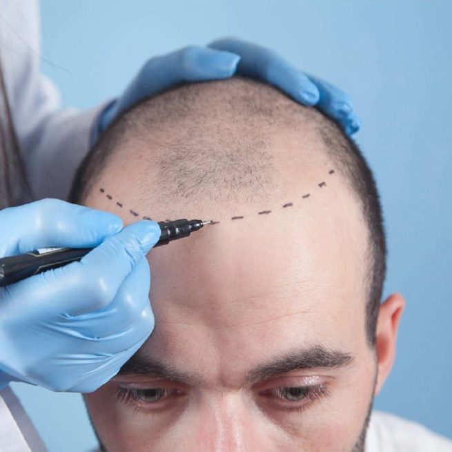 hairline reconstruction