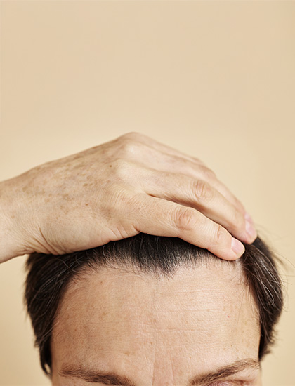 Reason behind alopecia